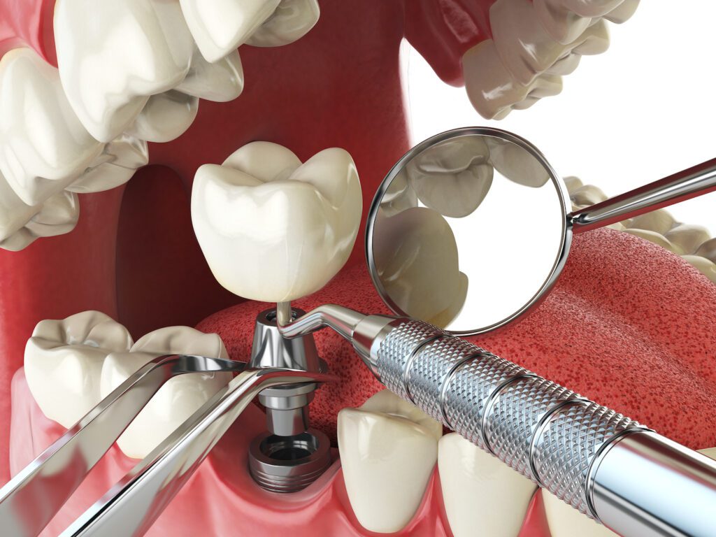 If you have missing teeth, dental implants are often recommended as the most effective and natural way to replace them.